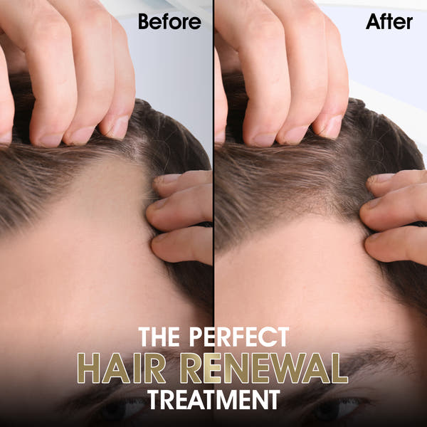 Derma Roller 0.25mm Luxury Gold Edition (for Face, Hair, Skin, Beard)