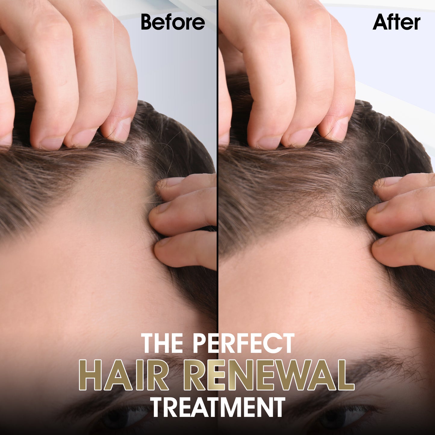 Derma Roller 0.25mm Luxury Gold Edition (for Face, Hair, Skin, Beard)