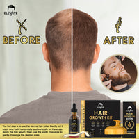 Elevate 3-in-1 Hair Derma Roller Kit