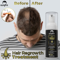 Elevate 5% Minoxidil Hair Growth Foam